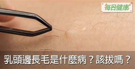 男生奶頭長毛|乳頭邊長了毛，是什麼病？該不該拔？讓名醫一次解釋給您聽｜每